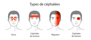 Douleurs cervicales responsables des maux de tête